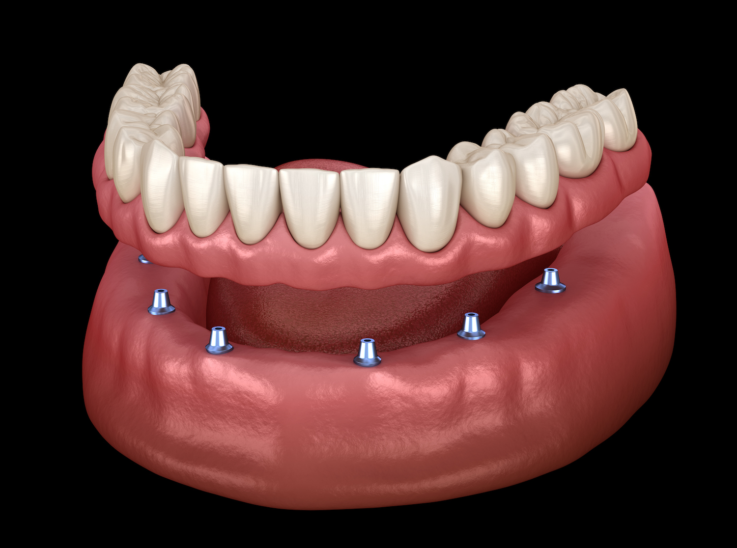 All-on-X full arch restoration