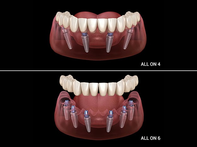All-on-X implant placement