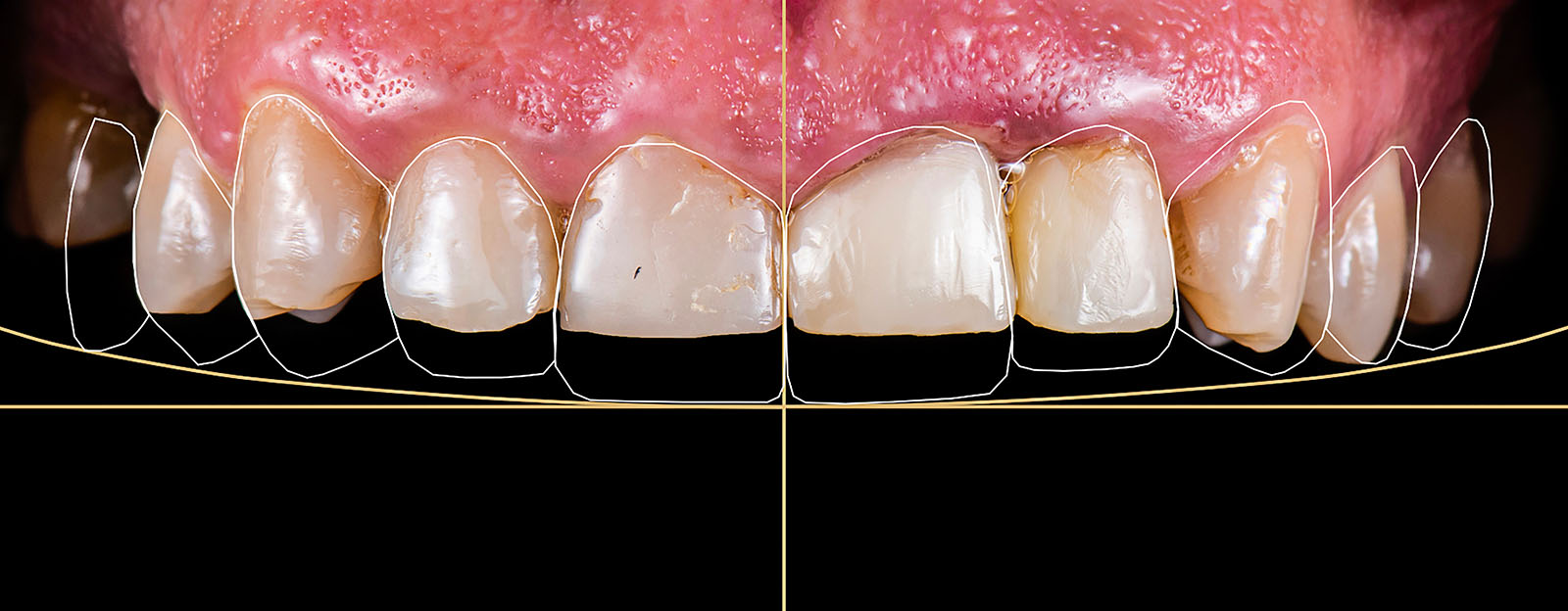 Cosmetic dentistry smile design analysis