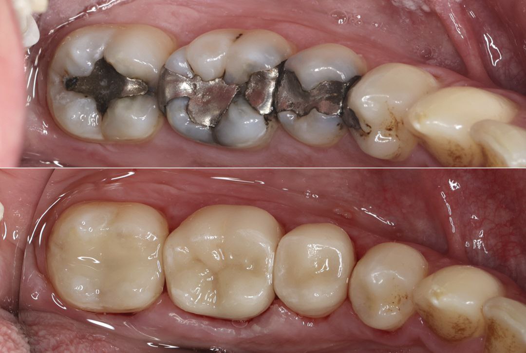Why dental crowns are needed