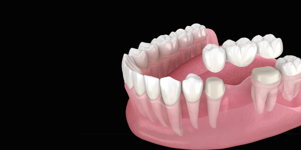 Dental bridge restoration