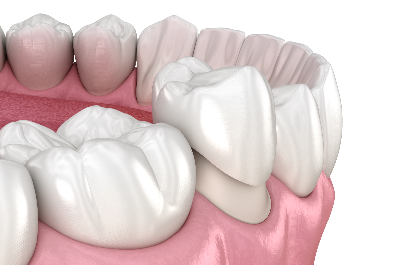 The dental crown process