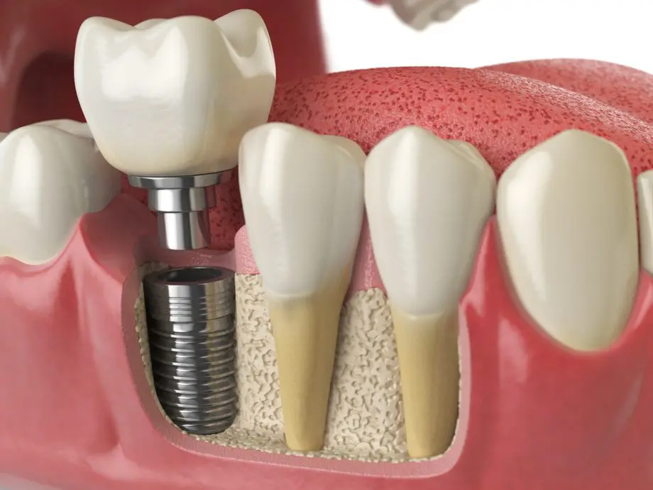 Dental implant components