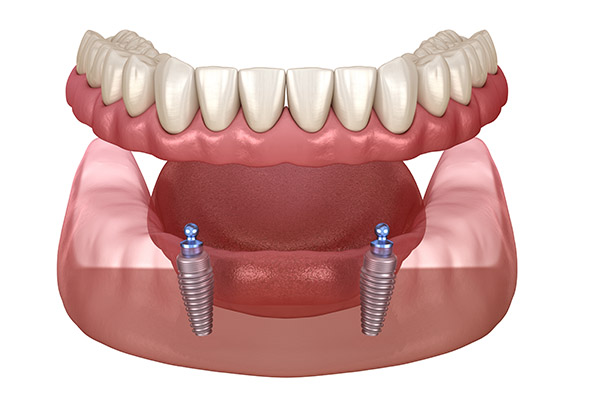 Overdenture attachment system