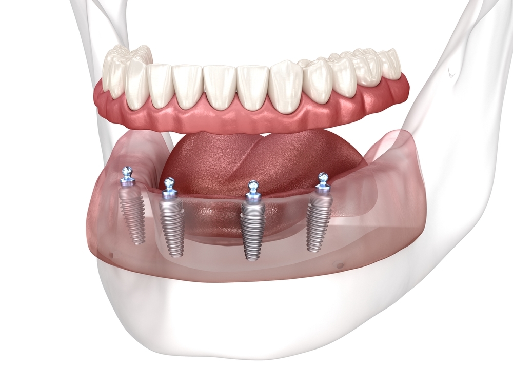 Implant-supported overdenture