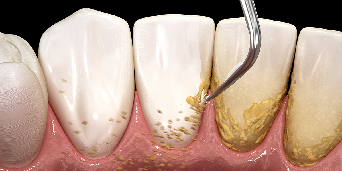 Periodontal treatment process