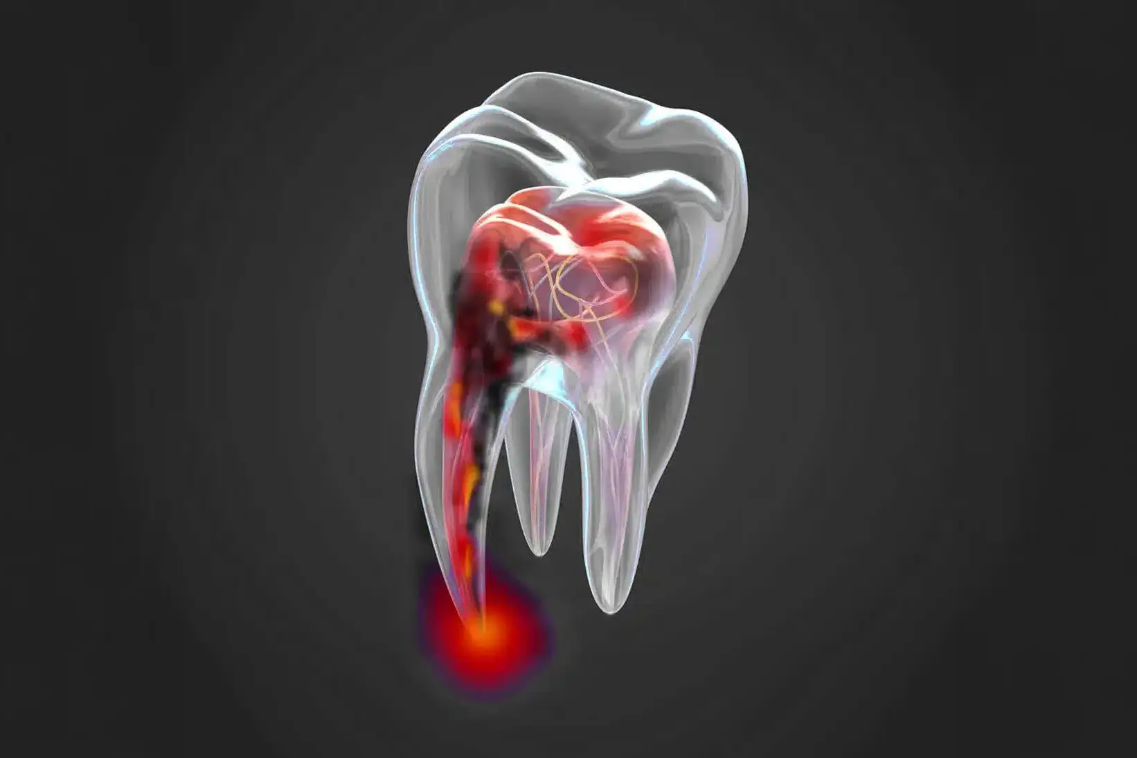 Why root canal is needed