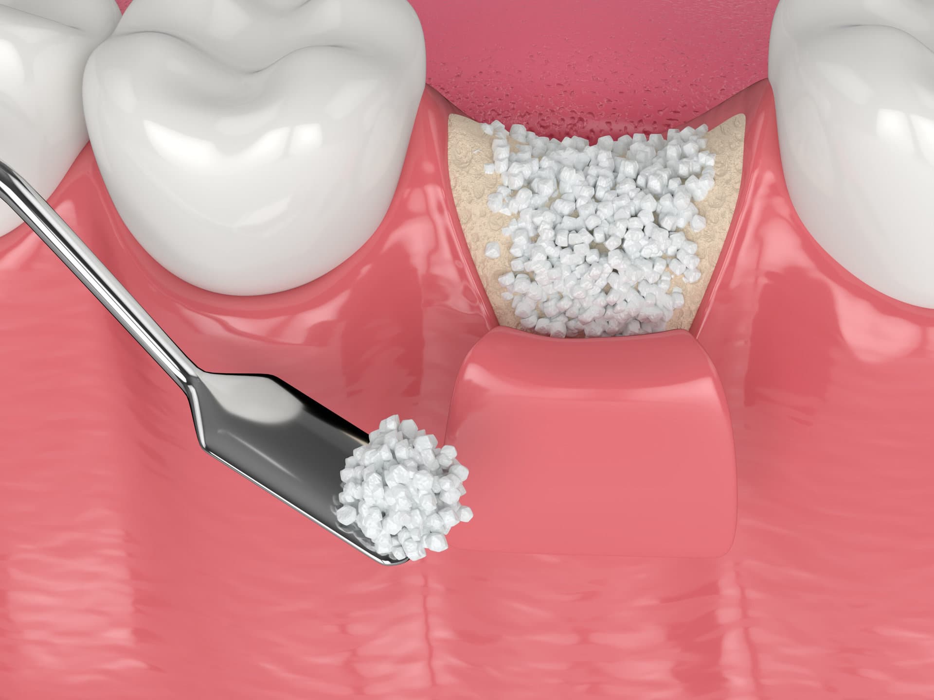Bone graft material in extraction socket