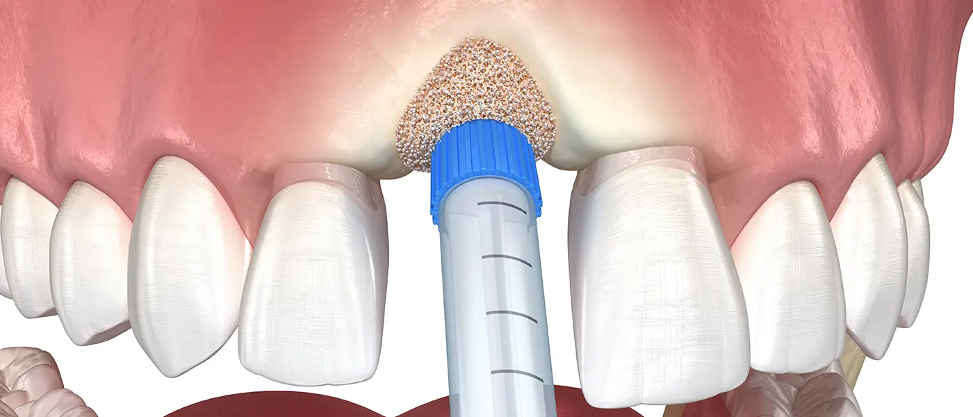 Socket preservation procedure