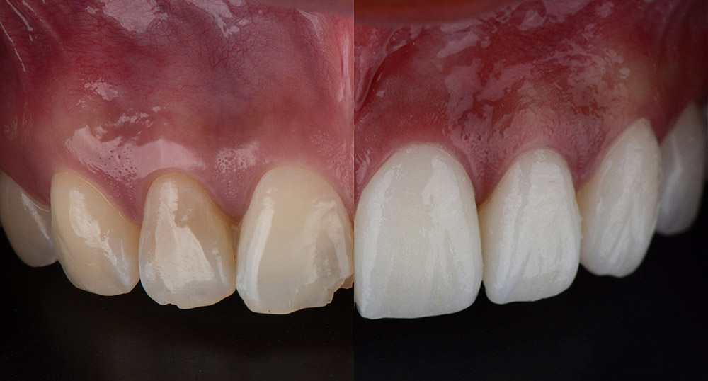 Veneer before and after