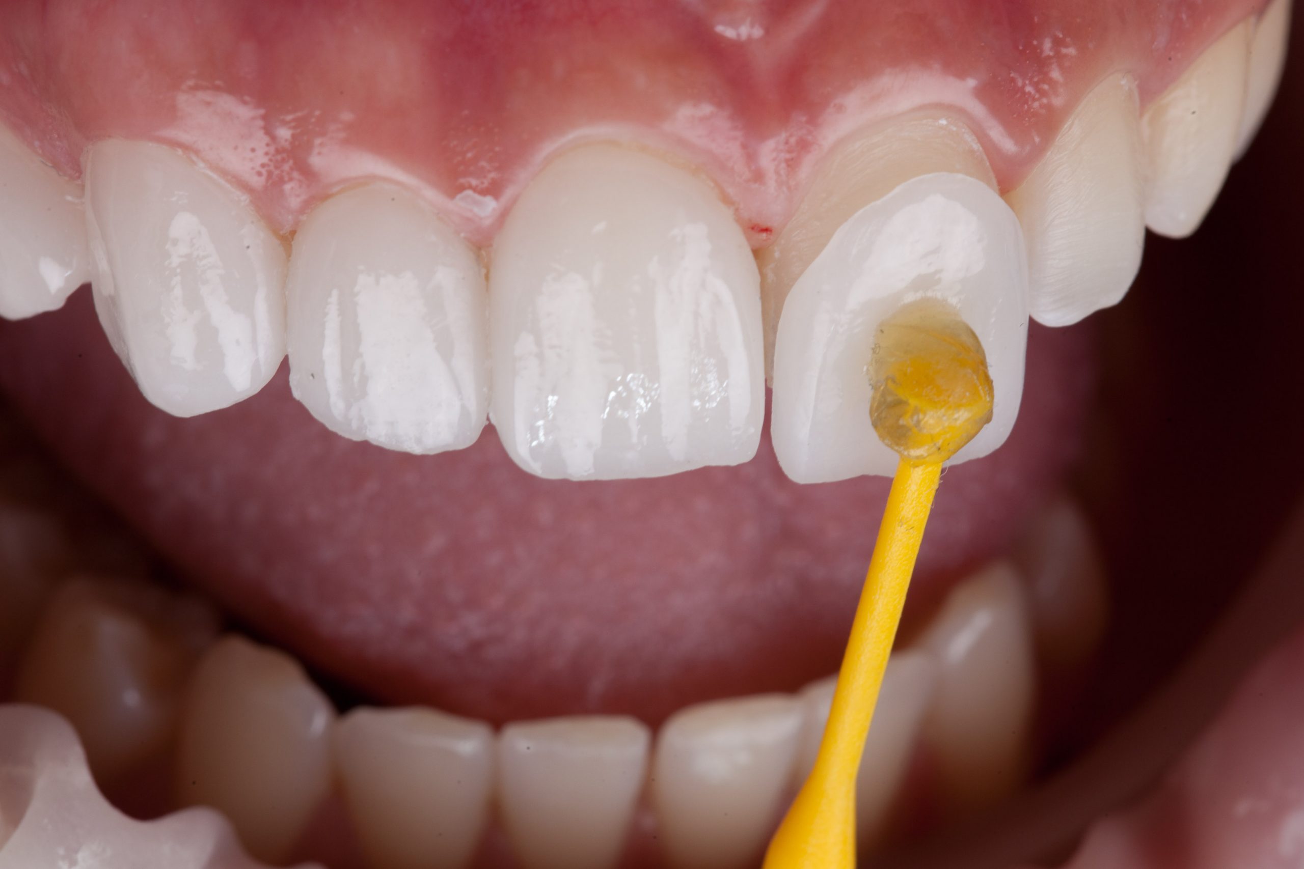 Veneer before and after results