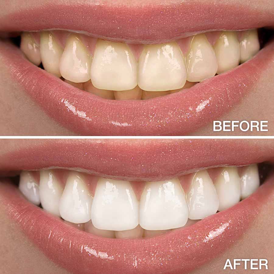 Why teeth whitening is needed